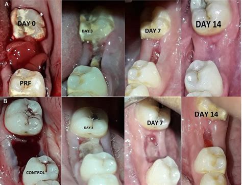 Pain can be noticeable as early as day 3 after extraction. . Pictures of dry socket vs normal healing